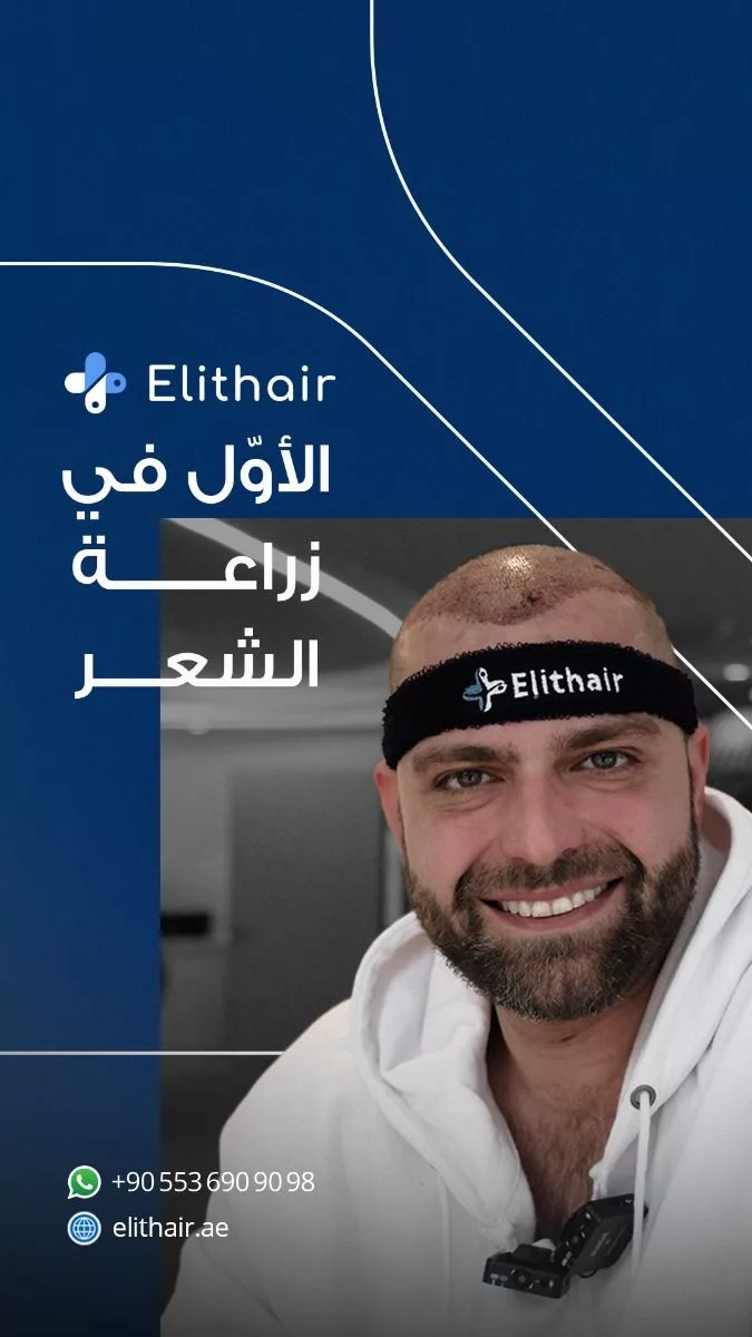 الشعر في تركيا زراعة الشعر في دبي زراعة الشعر قبل وبعد مشفى إليت هير jpeg